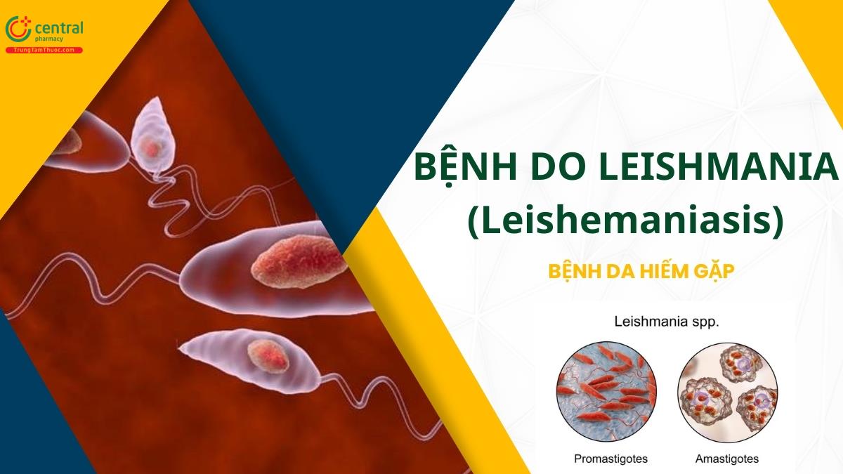 Nguyên nhân, biểu hiện, cách phòng bệnh do Leishmania (Leishemaniasis)