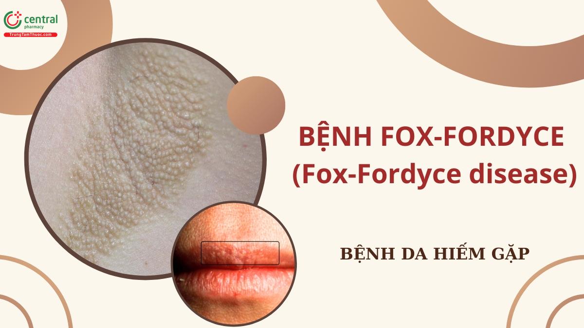 Bệnh Fox-Fordyce (Fox-Fordyce disease): Cơ chế bệnh sinh, biểu hiện lâm sàng