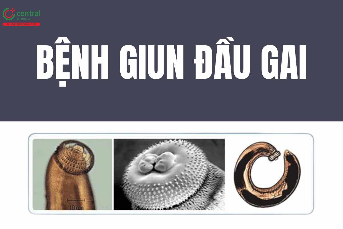 Bệnh giun đầu gai (Gnathostoma) có nguy hiểm không? Tác hại và phác đồ điều trị của Bộ Y tế