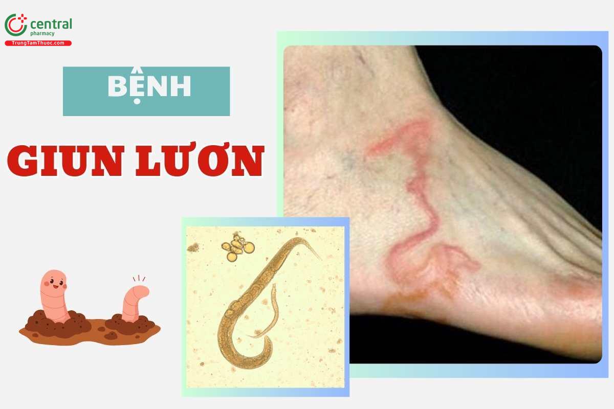 Bệnh giun lươn (Strongyloidiasis) có chữa được không? Triệu chứng và cách điều trị theo phác đồ Bộ Y tế