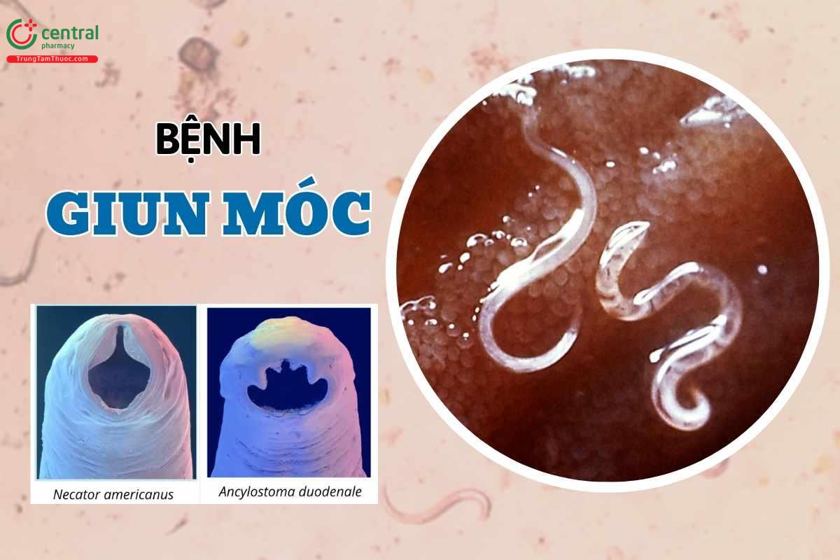 Giun móc (Ancylostoma) gây ra bệnh gì? Nguyên nhân, biểu hiện và cách phòng ngừa lây nhiễm