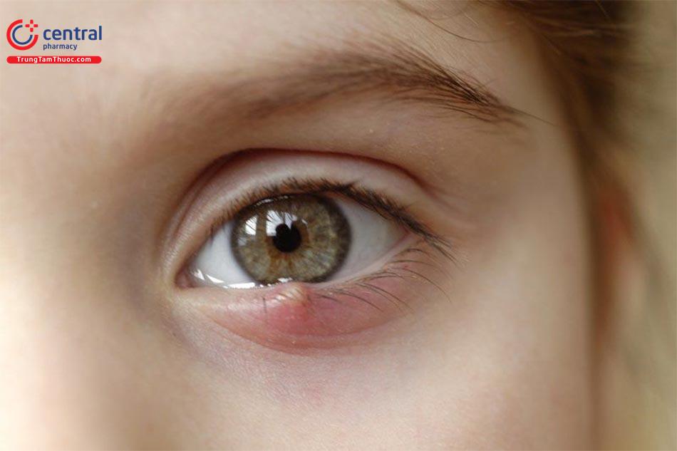 Bệnh lẹo mắt: triệu chứng, nguyên nhân và cách phòng ngừa lẹo