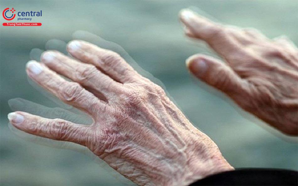 Bệnh Parkinson: nguyên nhân, triệu chứng và điều trị