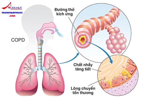 Bệnh phổi tắc nghẽn mạn tính đợt cấp và cách xử trí