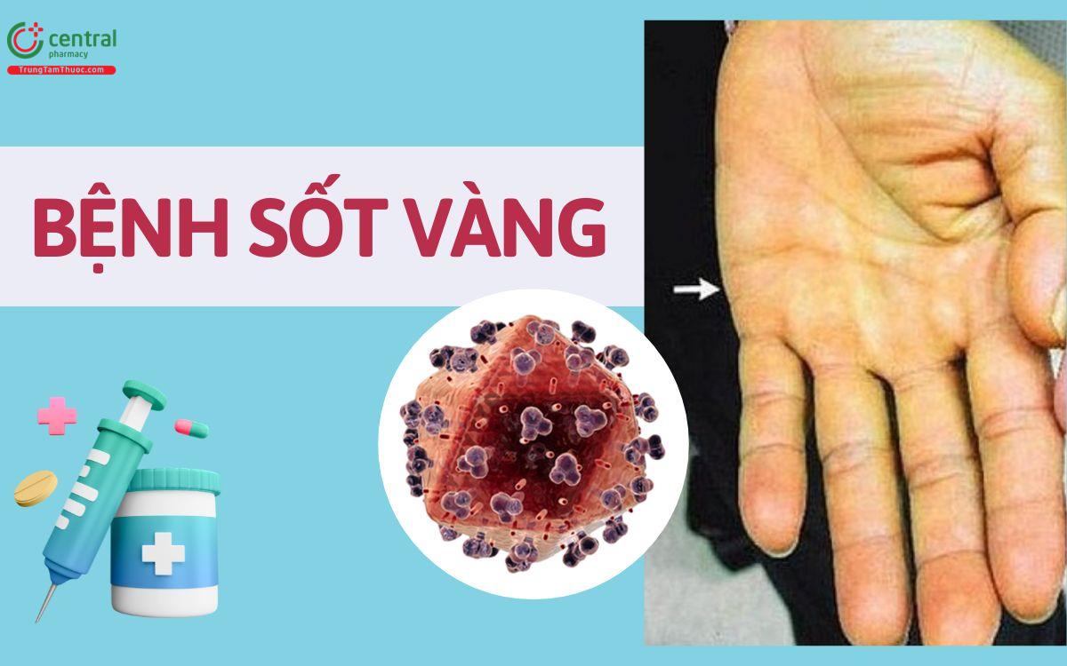 Bệnh sốt vàng: nguyên nhân, triệu chứng, chẩn đoán và vắc xin điều trị