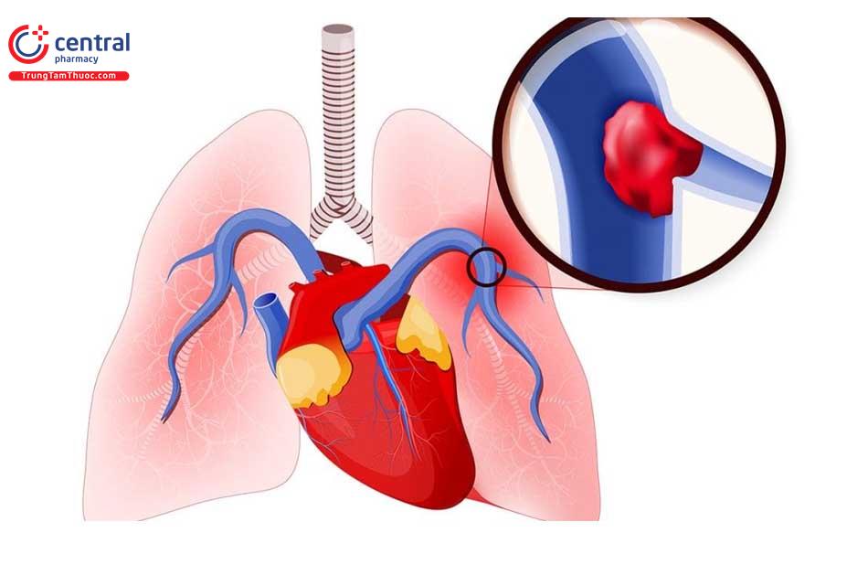 Bệnh tắc động mạch phổi cấp: chẩn đoán và hướng dẫn điều trị