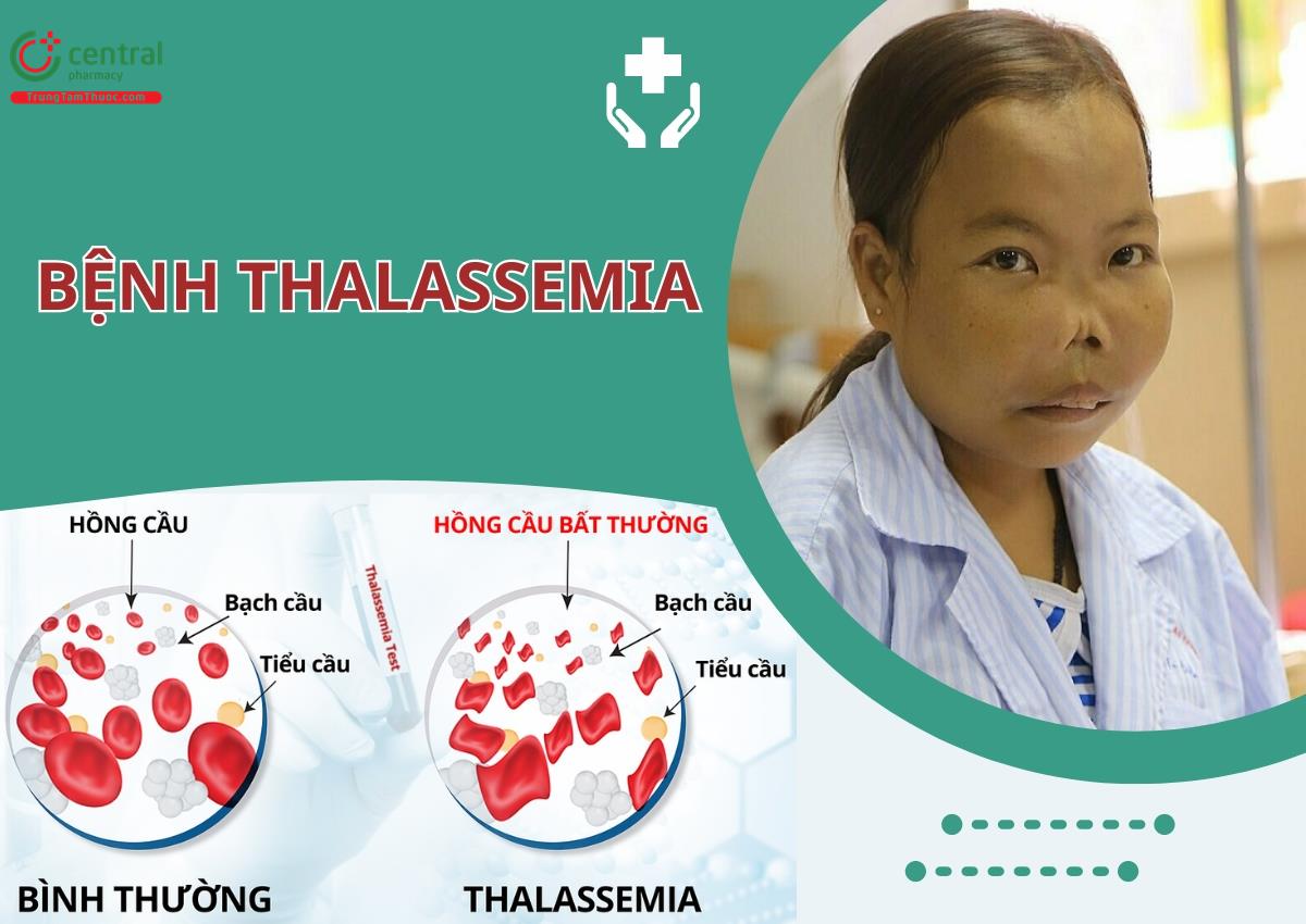 Bệnh Thalassemia: Cơ chế di truyền, cách chẩn đoán, điều trị và phòng bệnh