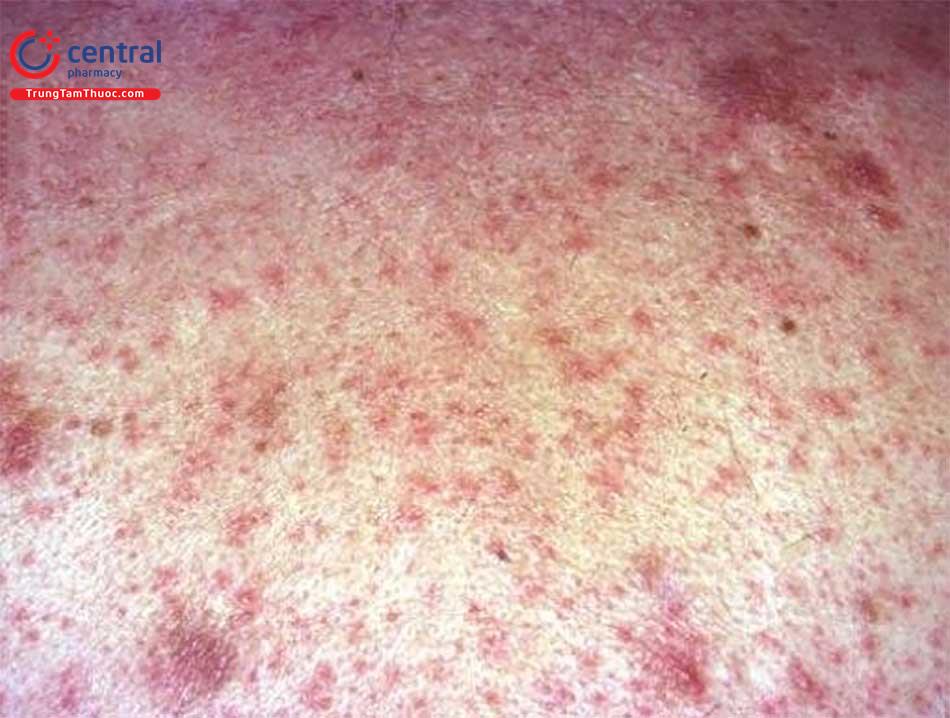 Bệnh thoái hóa bột và các tổn thương trên da (amyloidosis)