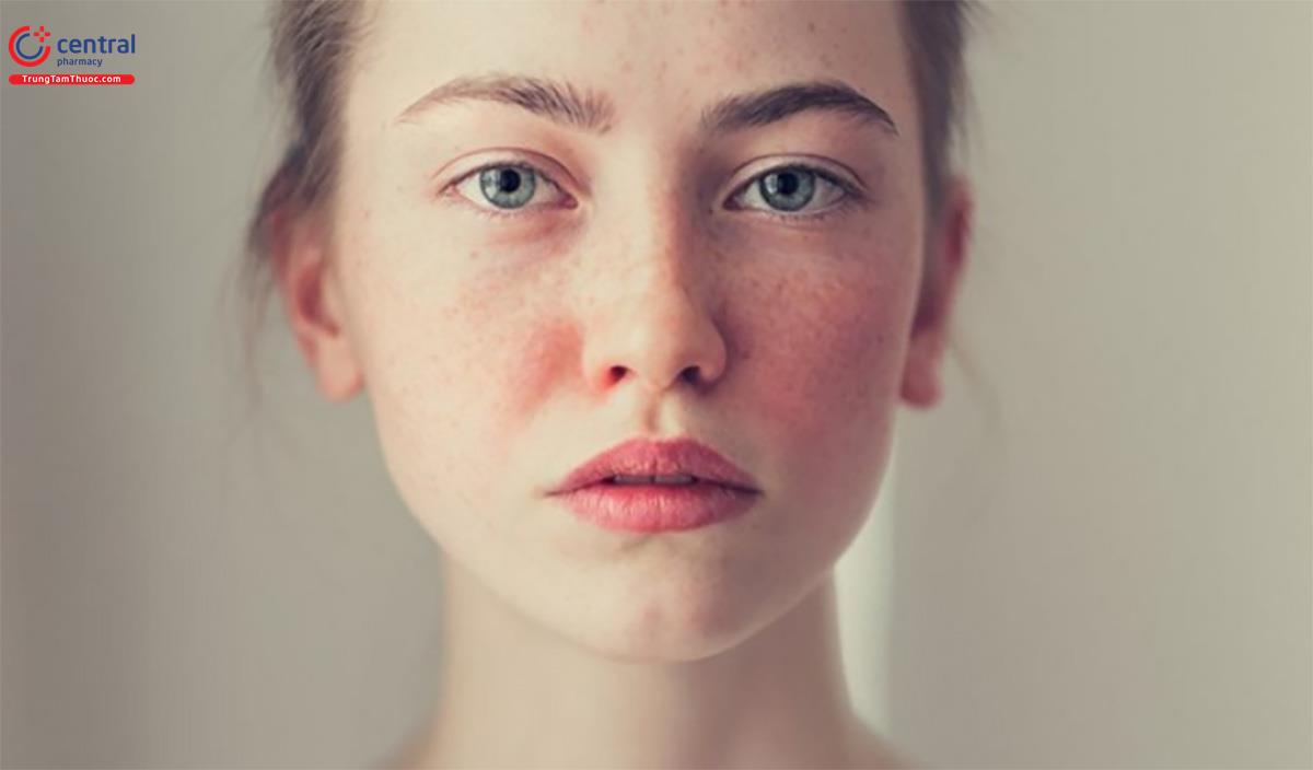 Bệnh trứng cá đỏ (Rosacea) có thật sự đáng sợ như chị em từng nghĩ?