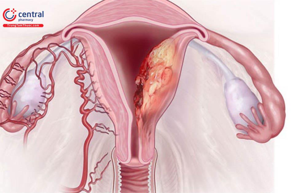 Hướng dẫn phân biệt u buồng trứng lành tính và ung thư buồng trứng