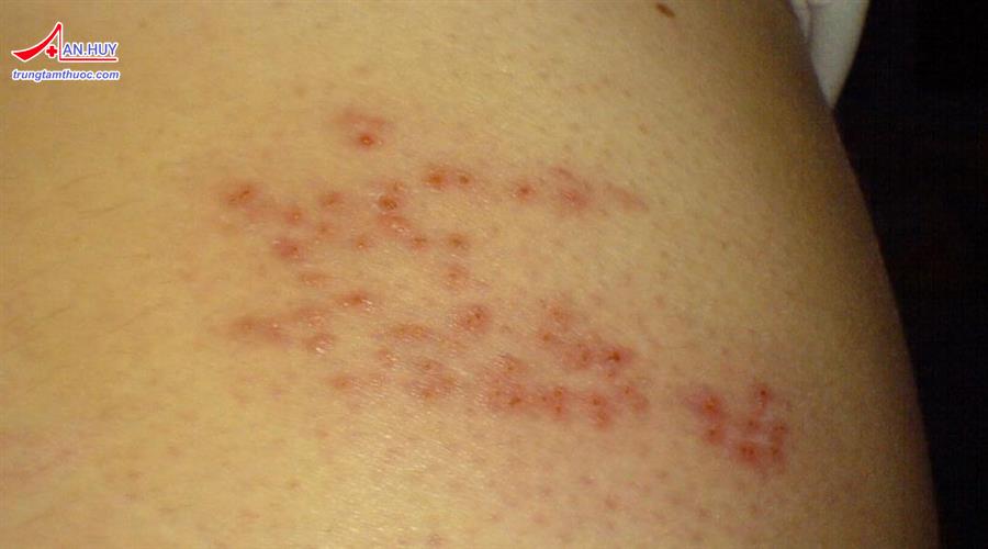 Bệnh giời leo: nguyên nhân, triệu chứng và điểu trị