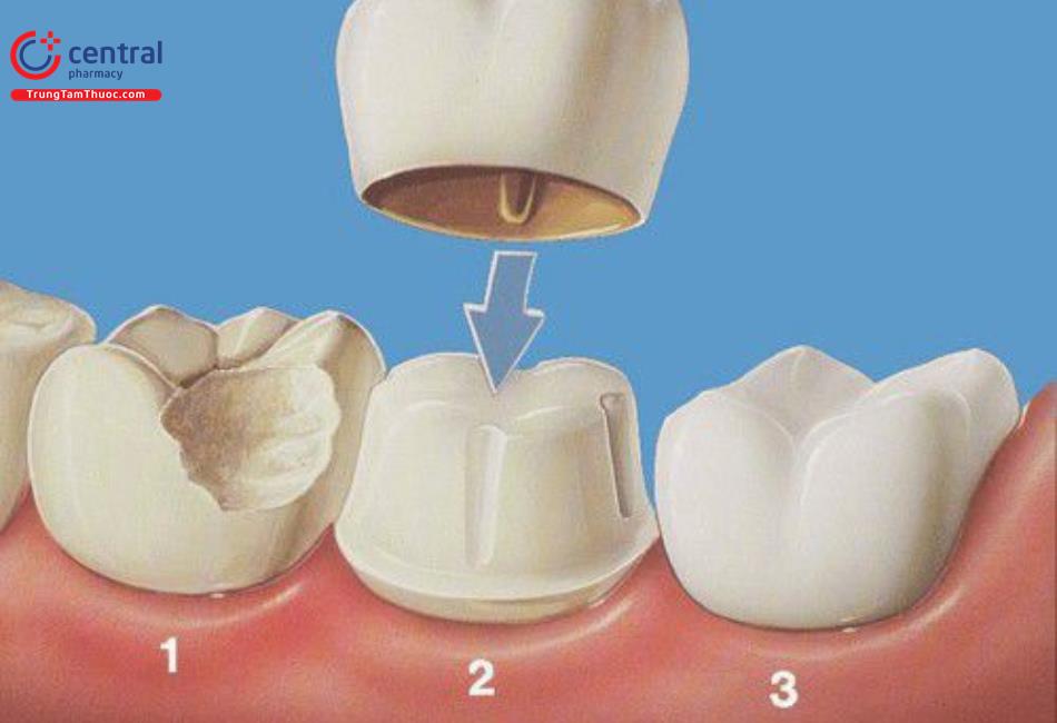 Bọc răng sứ chi phí bao nhiêu có đau không? 5 hậu quả bọc răng sứ