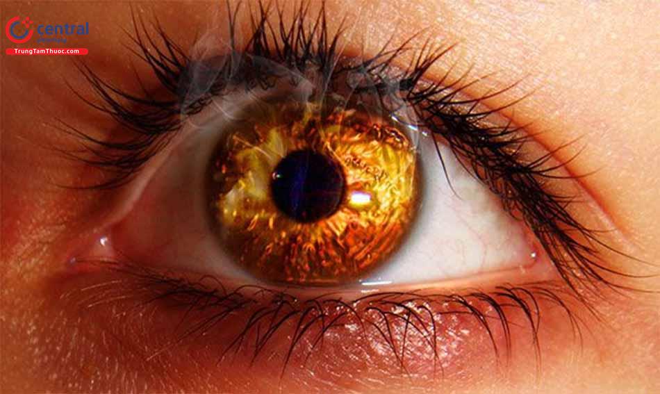 Bỏng mắt do hóa chất: Cách sơ cứu đúng cách nhất, điều trị