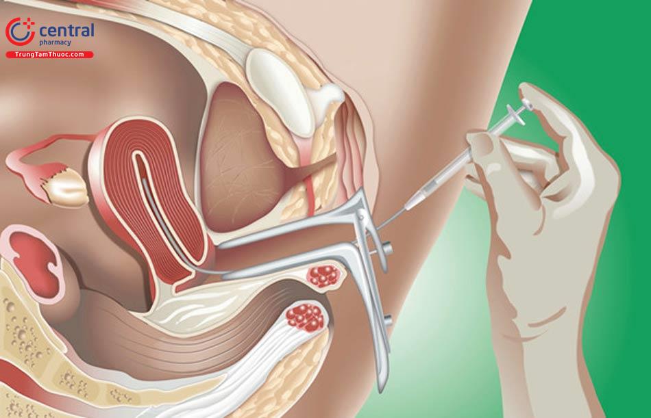 Các bước trong kỹ thuật bơm tinh trùng vào buồng tử cung