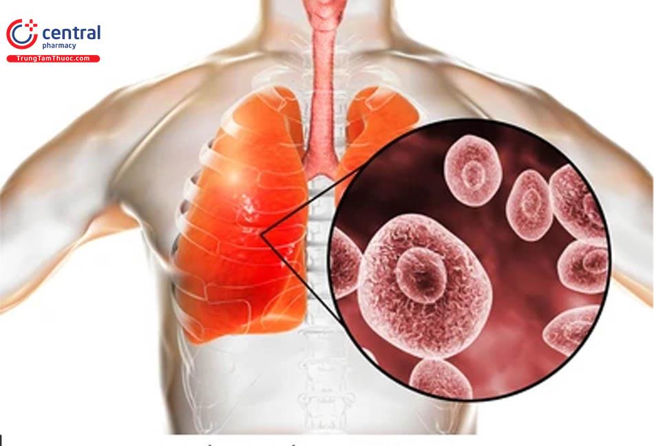 Các loại bệnh nấm phổi thường gặp và cách điều trị