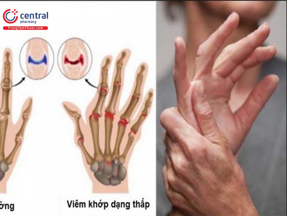 CÁC TIÊU CHUẨN CHẨN ĐOÁN ĐỢT TIẾN TRIỂN CỦA BỆNH VIÊM KHỚP DẠNG THẤP