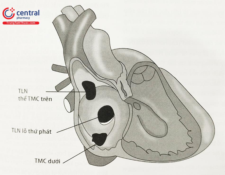 Can thiệp bít thông liên nhĩ - Phẫu thuật tim bẩm sinh
