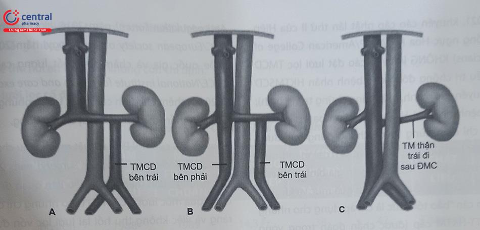 Tìm hiểu can thiệp đặt lưới lọc tĩnh mạch chủ dưới