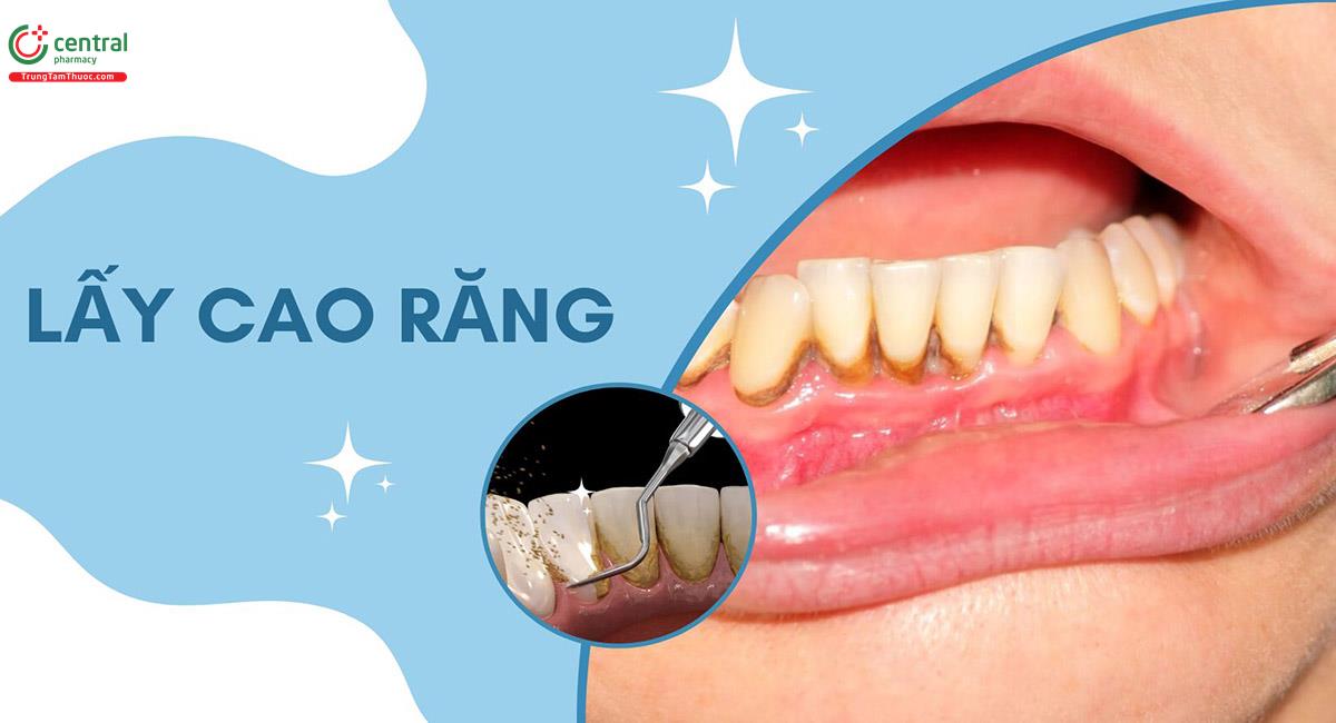 Cao răng (vôi răng) là gì? Tác dụng, tác hại của việc lấy cao răng