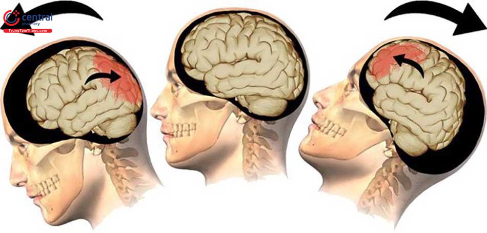 Chấn thương sọ não: nguyên nhân, triệu chứng, điều trị và phòng ngừa