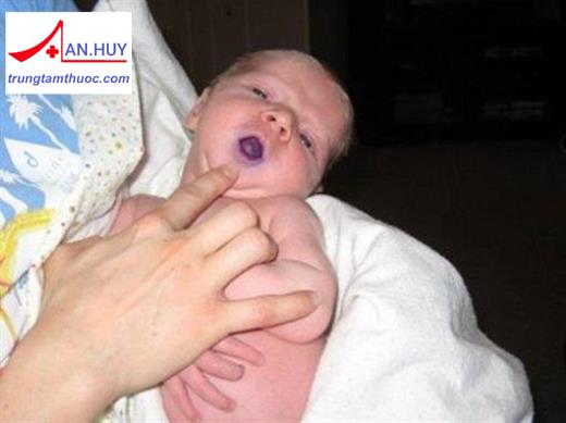 Phác đồ điều trị cơn tím ở trẻ em mắc tứ chứng Fallot