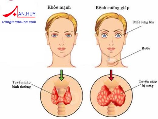 Cường giáp: nguyên nhân gây bệnh, cơ chế và triệu chứng