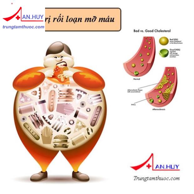 Cách điều trị rối loạn mỡ máu từ khuyến cáo của bộ y tế VN