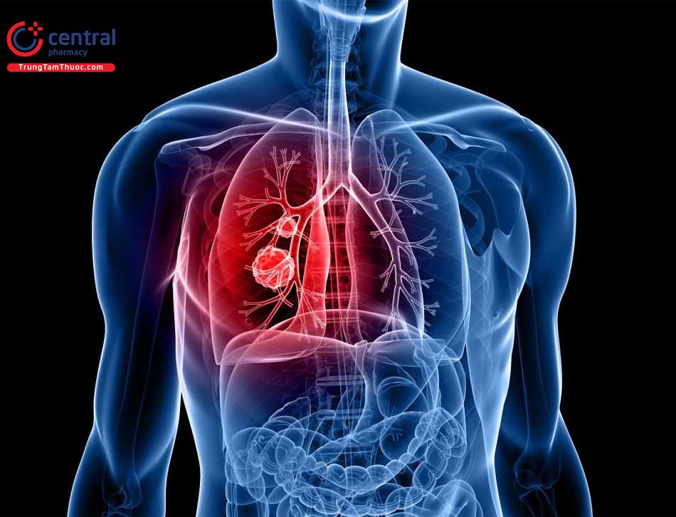 Điều trị ung thư phổi nguyên phát bằng hóa chất 