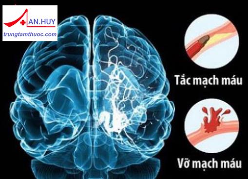 Đột quỵ não: định nghĩa và các yếu tố nguy cơ gây đột quỵ