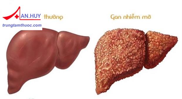 Nhận thức chung về gan nhiễm mỡ và những nguyên nhân gây bệnh