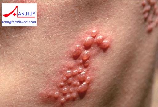 Herpes sinh dục: nguyên nhân, chẩn đoán và cách điều trị