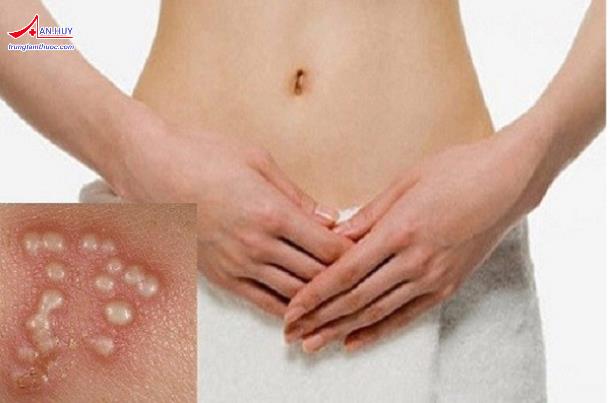 Herpes sinh dục: Triệu chứng, chẩn đoán và điều trị
