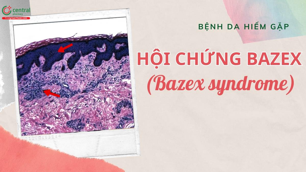 Hội chứng Bazex (Bazex syndrome) - Tình trạng dày sừng đầu cực có loạn sản