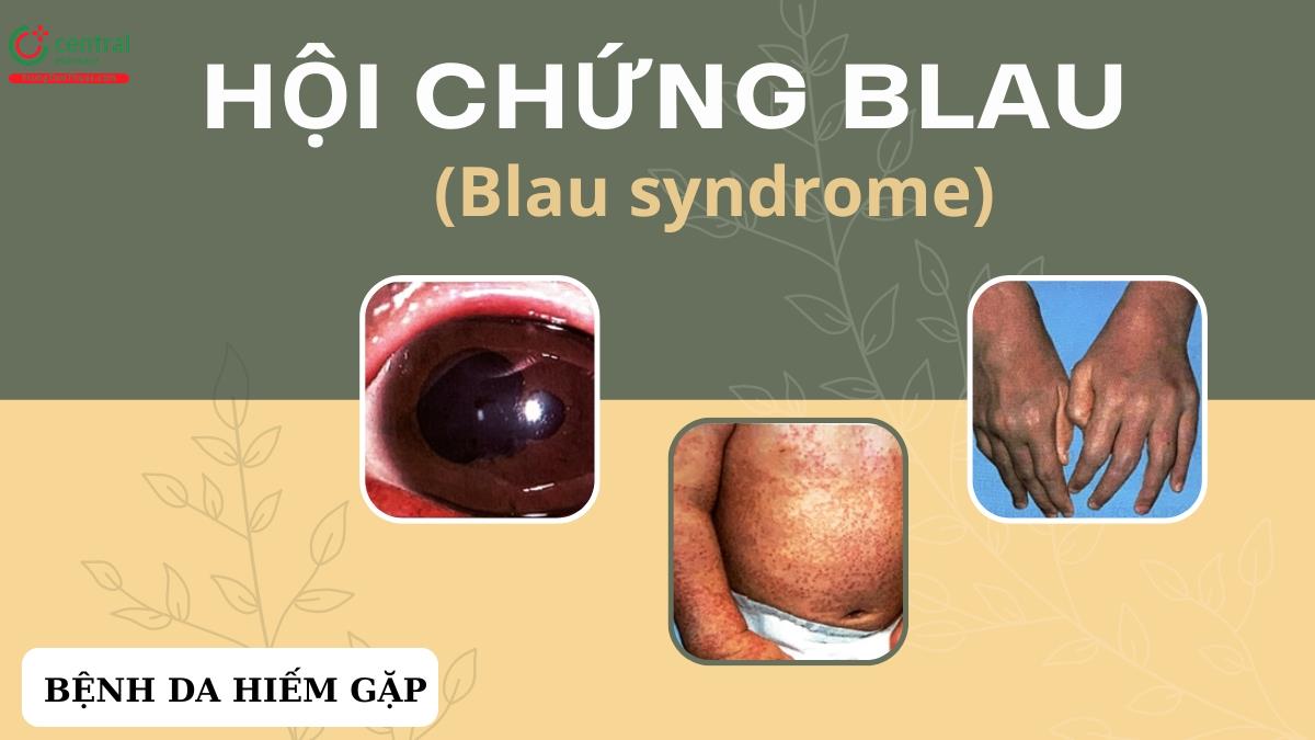 Hội chứng Blau (Blau syndrome): biểu hiện lâm sàng, chẩn đoán và điều trị