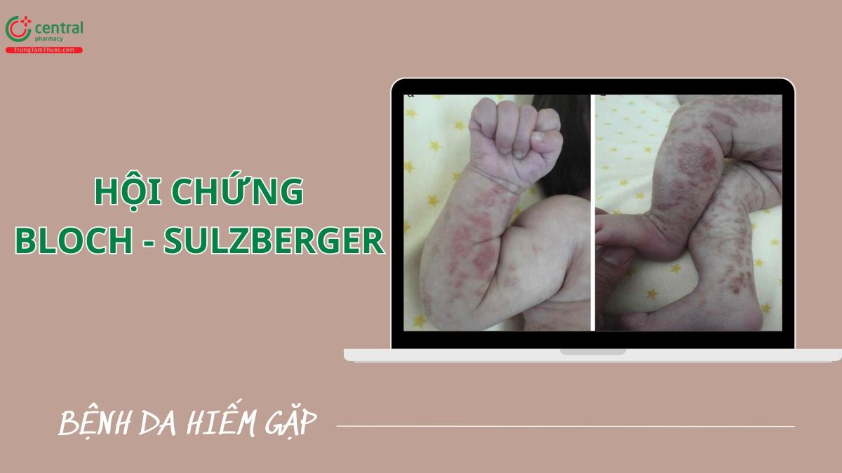 Hội chứng Bloch - Sulzberger: sinh bệnh học, biểu hiện và cách chẩn đoán