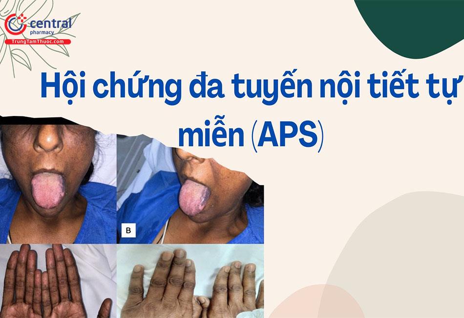 Tổng quan hội chứng đa tuyến nội tiết tự miễn (APS)