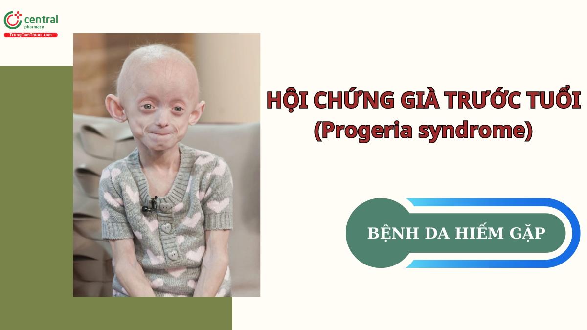 Chẩn đoán và điều trị hội chứng già trước tuổi (Progeria syndrome)