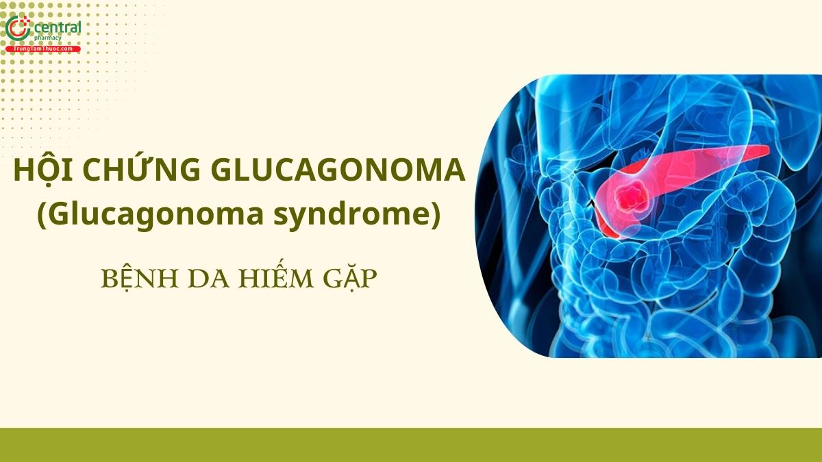 Biểu hiện lâm sàng, chẩn đoán, điều trị Hội chứng Glucagonoma (Glucagonoma syndrome)