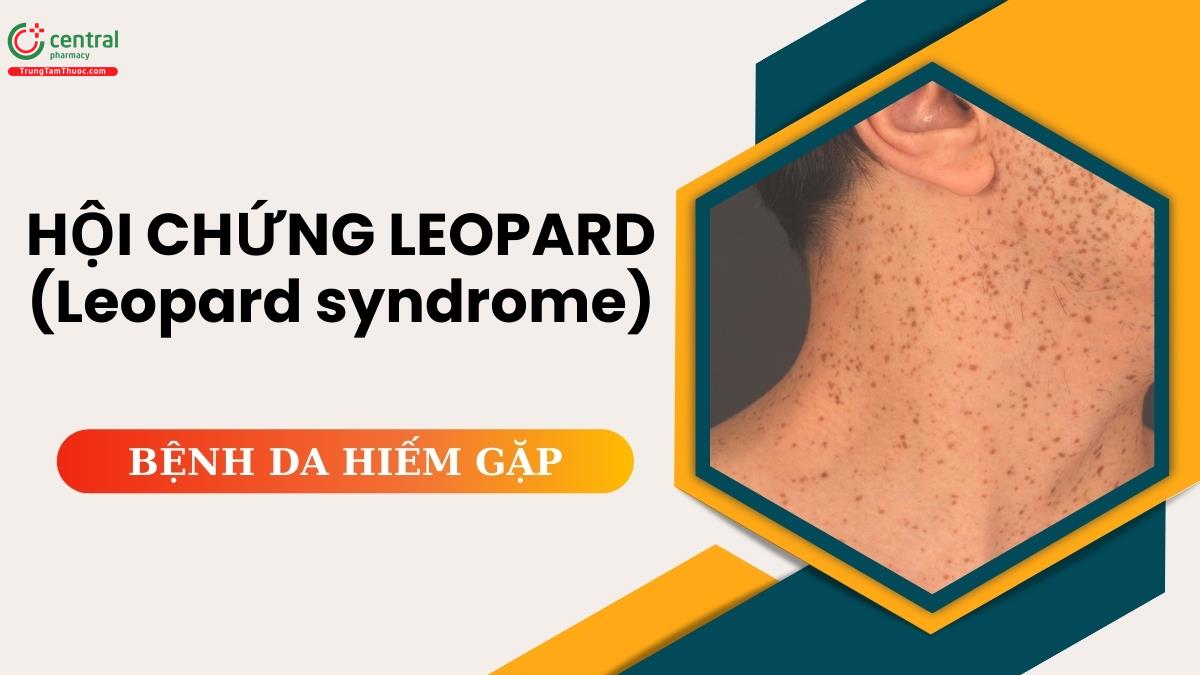 Hội chứng Leopard (Leopard syndrome) - Rối loạn hiếm gặp do đột biến gen