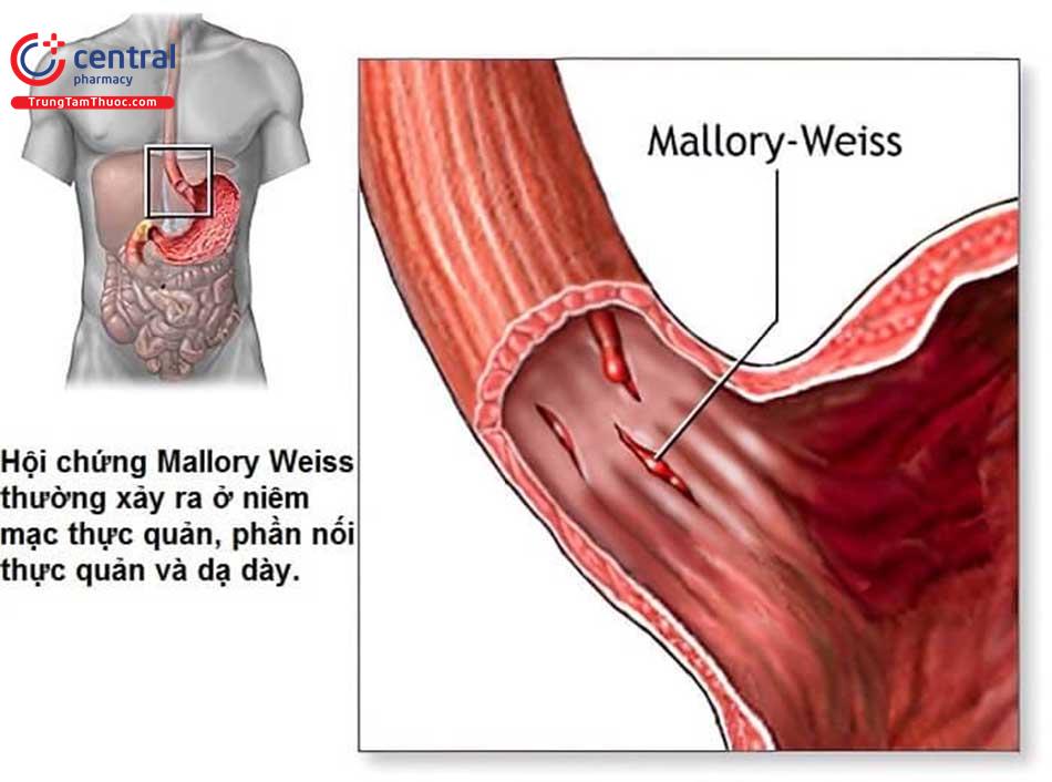 Hội chứng Mallory-Weiss: định nghĩa, nguyên nhân, hướng dẫn điều trị