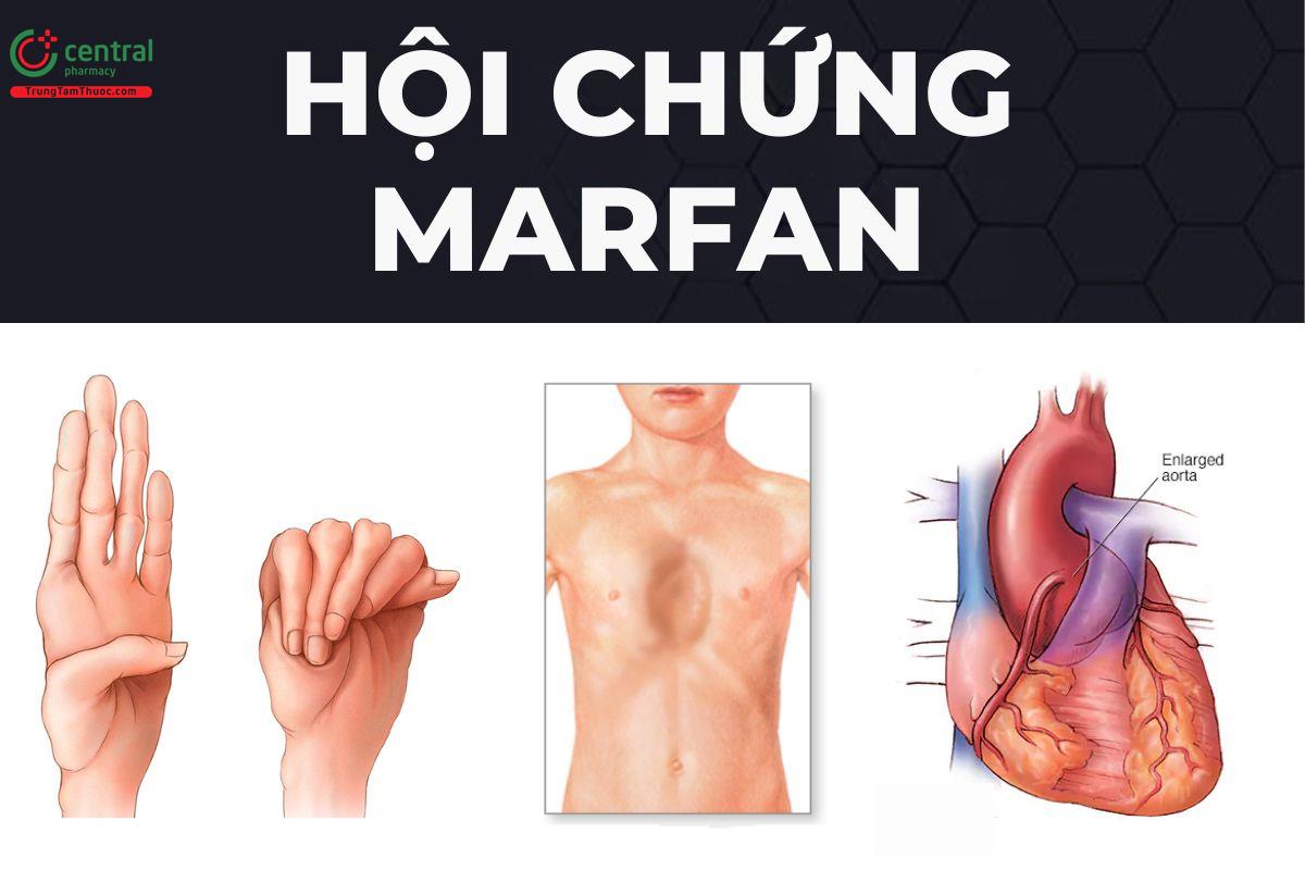 Hội chứng Marfan là đột biến gì? Nguyên nhân, triệu chứng và cách điều trị