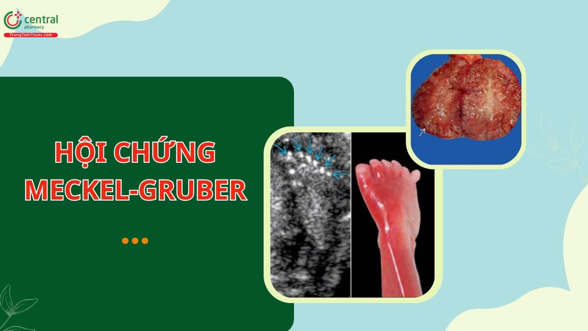 Hội chứng Meckel-Gruber: bệnh học, biểu hiện lâm sàng và cách chẩn đoán