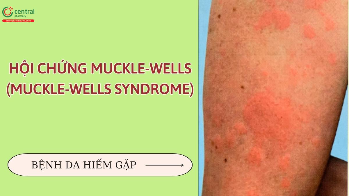 Hội chứng Muckle-Wells (Muckle-Wells syndrome): biểu hiện, chẩn đoán và điều trị