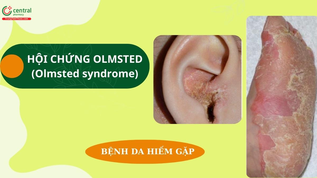 Tìm hiểu cách chẩn đoán và điều trị Hội chứng Olmsted (Olmsted syndrome)