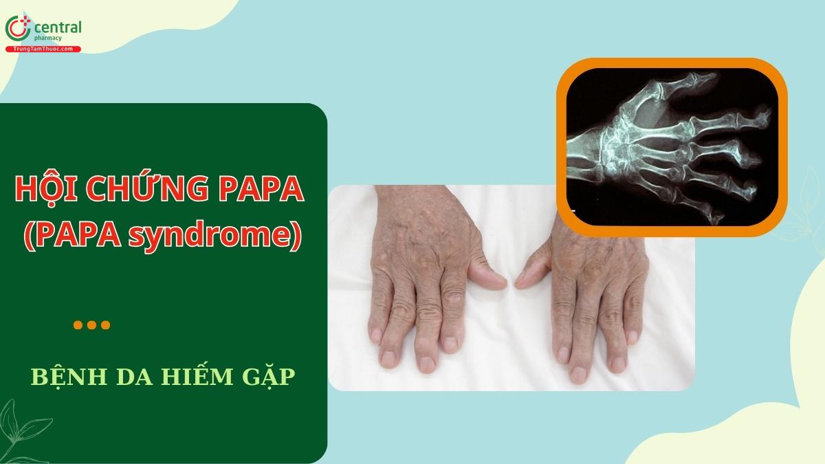 Hội chứng PAPA (PAPA syndrome) - Tình trạng tự viêm do di truyền trội