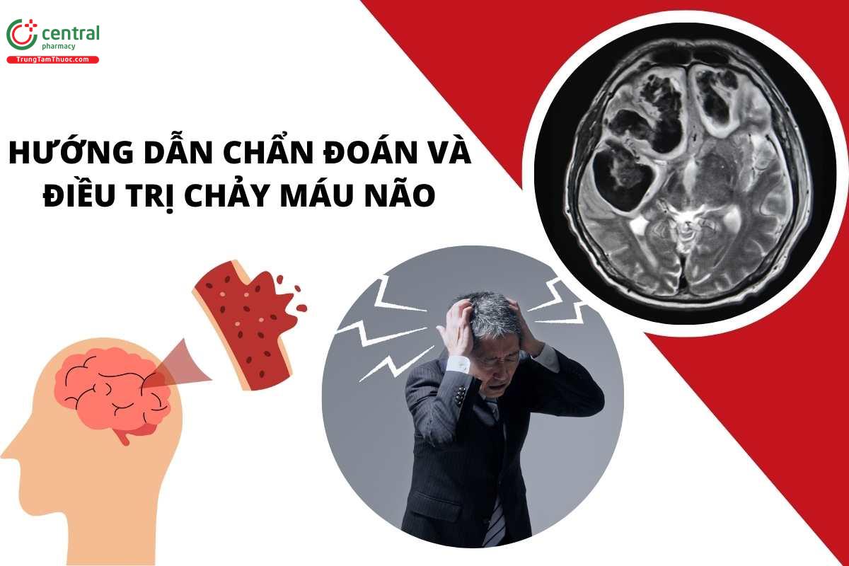 Hướng dẫn chẩn đoán và điều trị chảy máu não - Bộ Y tế