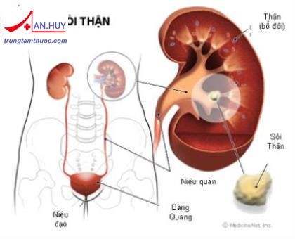 ĐIỀU TRỊ NỘI KHOA BỆNH SỎI THẬN TIẾT NIỆU