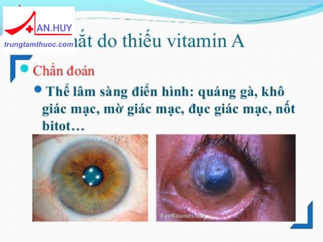 Bệnh khô mắt do thiếu vitamin A: triệu chứng và cách điều trị