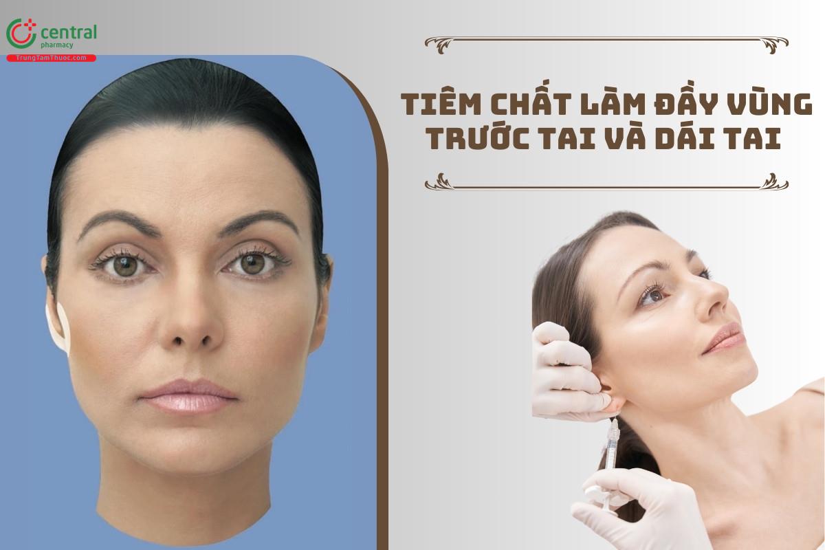 Kỹ thuật tiêm chất làm đầy vùng trước tai và dái tai trong thẩm mỹ