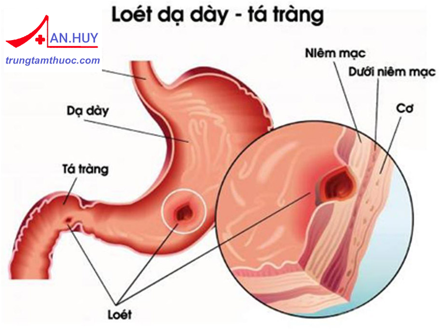 Loét dạ dày tá tràng: nguyên nhân, triệu chứng, điều trị bệnh